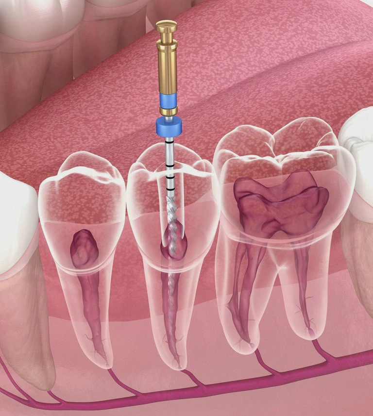 endodoncja